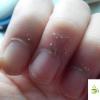 生活小知識：如何正確處理手上的倒刺？倒刺發炎了怎么辦？