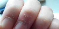 生活小知識:如何正確處理手上的倒刺?倒刺發炎了怎么辦?