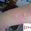生活小知識：被蚊子咬后，怎樣止癢快速有效？