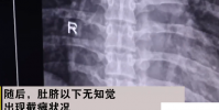90后男子做俯臥撐致下身癱瘓