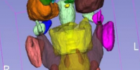 研究人員開發了深度學習技術來識別CT掃描中的ID風險解剖