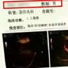 廣東中山一男子腹痛查B超檢出宮內胚胎存活