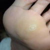 輕度的雞眼可以使用以下兩個中醫小秘方 