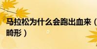 馬拉松為什么會跑出血來(馬拉松為什么腳會畸形)