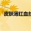 皮膚薄紅血絲怎么辦（下面提供幾種方法）