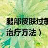 腿部皮膚過敏怎么辦（給大家介紹一些基本的治療方法）