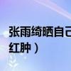 張雨綺曬自己腿部受傷照片（昔日美腿現淤青紅腫）