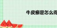 牛皮癬是怎么得的?