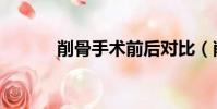 削骨手術前后對比(削骨手術)