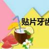 貼片牙齒對牙齒有傷害嗎（貼片）