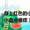 身上紅色的小血點像痣怎么治療（身上紅色的小血點像痣）