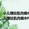 小兒橫紋肌肉瘤中P_16和PRb蛋白的表達及其意義（關于小兒橫紋肌肉瘤中P_16和PRb蛋白的表達及其意義簡介）
