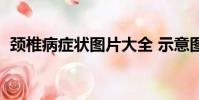 頸椎病癥狀圖片大全 示意圖(勁椎病癥狀)