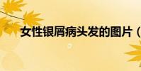 女性銀屑病頭發的圖片(女性銀屑病)