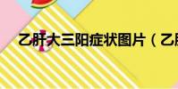 乙肝大三陽癥狀圖片(乙肝大三陽癥狀)