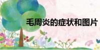 毛周炎的癥狀和圖片(毛周炎)