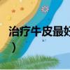治療牛皮最好的外用藥（治療牛皮最好的方法）