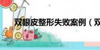雙眼皮整形失敗案例(雙眼皮整容術)