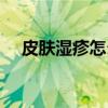皮膚濕疹怎么治療（皮膚濕疹怎么治療）