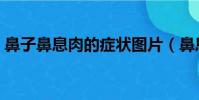 鼻子鼻息肉的癥狀圖片(鼻息肉的癥狀圖片)