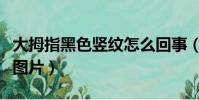 大拇指黑色豎紋怎么回事(大拇指有黑色豎紋圖片)
