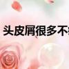 頭皮屑很多不癢沒有紅斑（頭皮屑很多不癢）