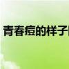 青春痘的樣子圖片（青春痘圖片有幾種類型）