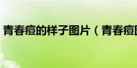 青春痘的樣子圖片(青春痘圖片有幾種類型)