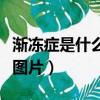 漸凍癥是什么病有什么癥狀（漸凍癥是什么病圖片）