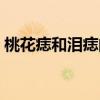 桃花痣和淚痣的照片（桃花痣和淚痣的區別）