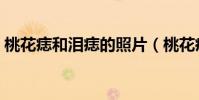 桃花痣和淚痣的照片(桃花痣和淚痣的區別)