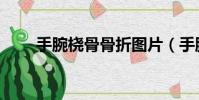 手腕橈骨骨折圖片(手腕骨折圖片)