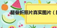 腿骨折照片真實圖片(腿骨折照片)