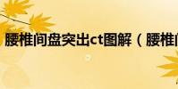 腰椎間盤突出ct圖解(腰椎間盤突出ct圖片)
