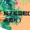 蚊子咬后起紅點多久可以消掉（蚊子咬后起紅點圖片）