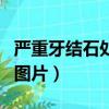 嚴重牙結石處理后應該怎么治療（重度牙結石圖片）