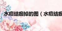 水痘結痂掉的圖(水痘結痂脫落后的圖片)
