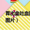 胃出血吐血圖片真實照片 出血（胃出血吐血圖片）