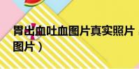 胃出血吐血圖片真實照片 出血(胃出血吐血圖片)