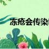 凍瘡會傳染嗎怎么治療（凍瘡會傳染嗎）