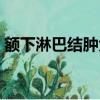 額下淋巴結腫大癥狀（額下淋巴結腫大圖片）