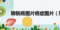 膀胱癌圖片癌癥圖片(膀胱癌圖片)