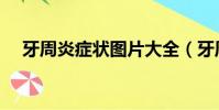 牙周炎癥狀圖片大全(牙周炎癥狀圖片)