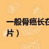 一般骨癌長在什么部位（骨癌一般都長在哪圖片）