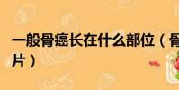 一般骨癌長在什么部位(骨癌一般都長在哪圖片)