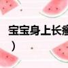 寶寶身上長癬是什么原因（寶寶身上長癬圖片）