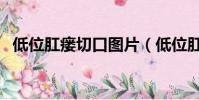 低位肛瘺切口圖片(低位肛瘺換藥步驟圖)