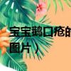 寶寶鵝口瘡的原因及防治辦法（寶寶鵝口蒼的圖片）