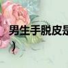 男生手脫皮是腎虛嗎（男生手脫皮是什么原因）