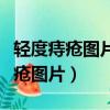 輕度痔瘡圖片和正常圖片對比實物圖（輕度痔瘡圖片）